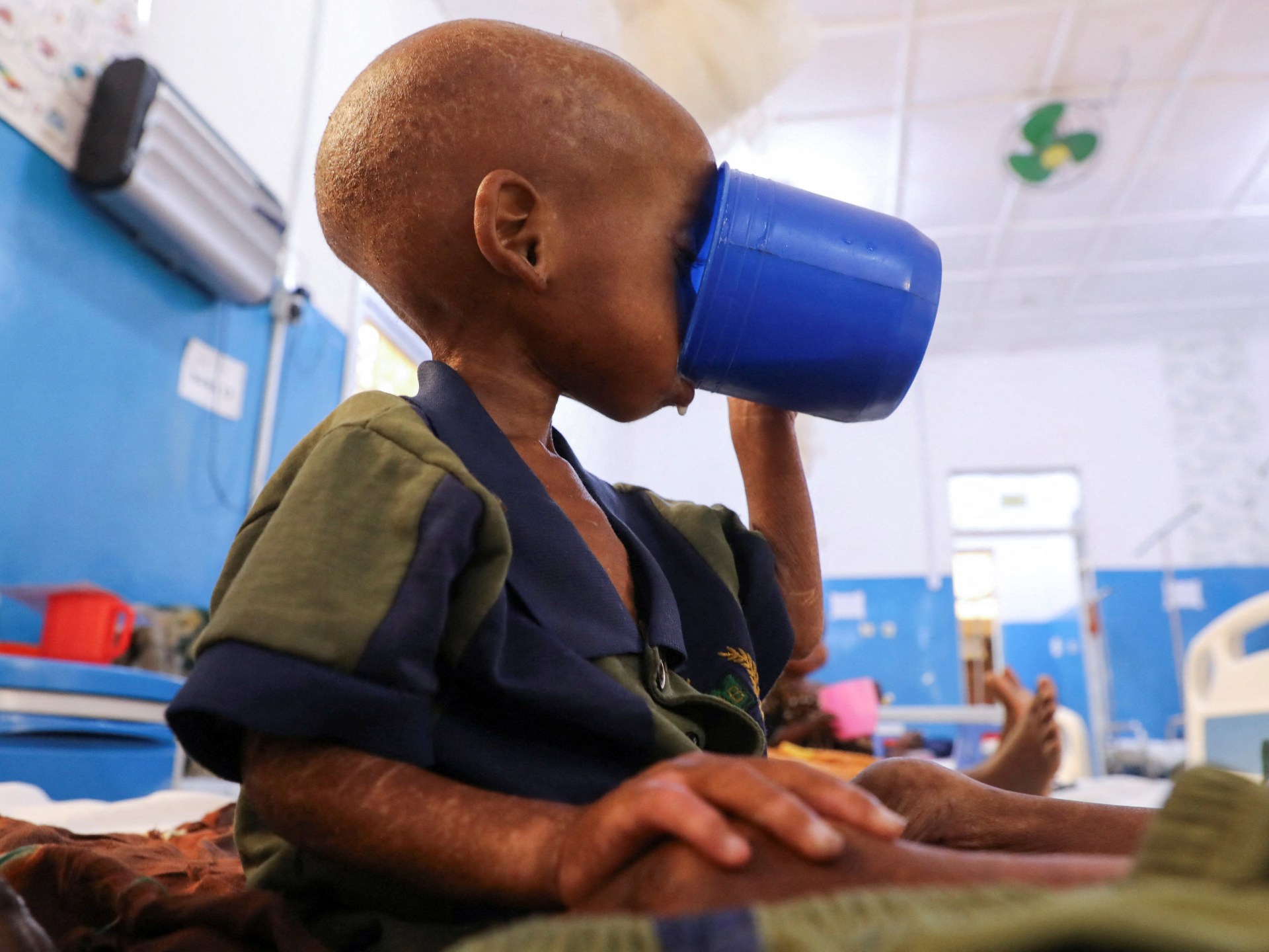 Aid cuts deepen Somalia’s child hunger crisis as clinics shut