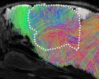 Human brain tissue fills half the brains of engineered mice